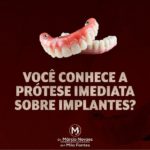 Você conhece a prótese imediata sobre implantes?