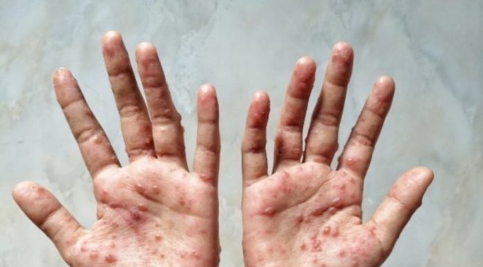 Pernambuco atualiza casos de monkeypox; Estado totaliza 1.705 notificações, dos quais 186 casos foram confirmados