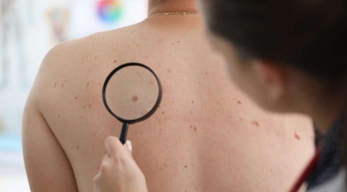 No mês do Dezembro Laranja, dermatologista do SESI-PE reforça importância do autoexame para prevenir câncer de pele