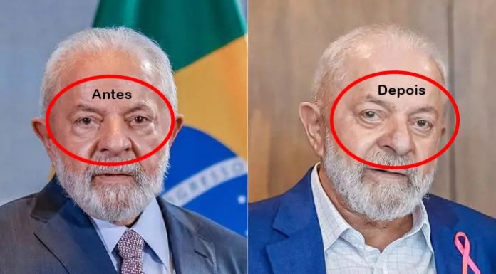 Veja antes e depois de Lula após cirurgia plástica; Planalto divulga primeiras imagens